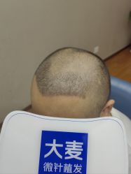 -大麦微针植发全国连锁