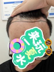 -大麦微针植发全国连锁