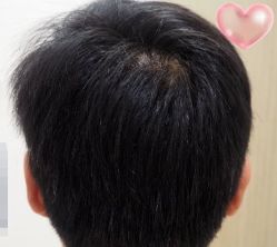 -大麦微针植发丨全国连锁