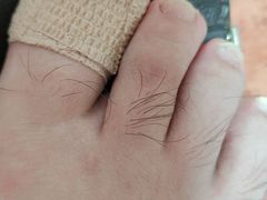 -祖传修脚甲沟炎灰指甲鸡眼