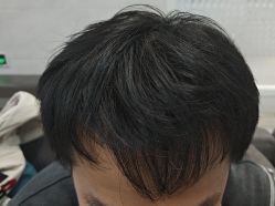 体验后-雍禾植发全国连锁