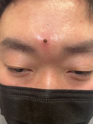 体验前-北京美痣堂古方祛痣斑疣瘊