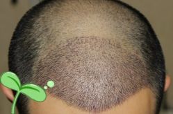 -大麦微针植发丨全国连锁