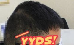 -大麦微针植发丨全国连锁