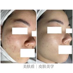 -美肤盾祛痘·问题肌头疗管理中心