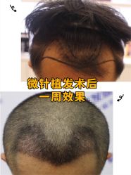 -大麦微针植发全国连锁