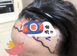 -大麦微针植发全国连锁