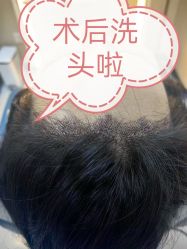 -大麦微针植发全国连锁
