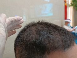 点击看大图 -碧莲盛·不剃发植发