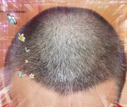 -大麦微针植发全国连锁