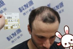 点击看大图 -大麦微针植发丨全国连锁