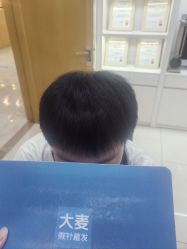 -大麦微针植发丨全国连锁