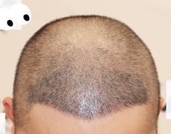 -大麦微针植发全国连锁