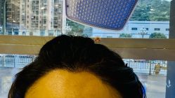 -碧莲盛·不剃发植发