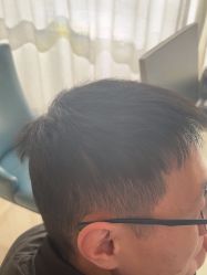 -大麦微针植发丨全国连锁