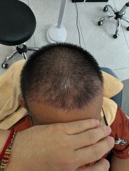 -大麦微针植发丨全国连锁