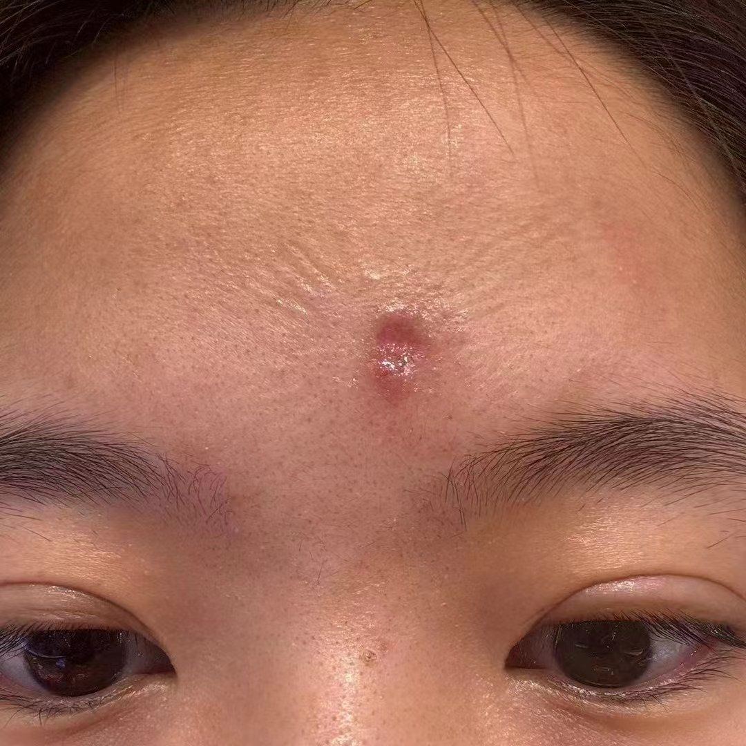 痘坑做2次做平了