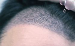 -大麦微针植发丨全国连锁