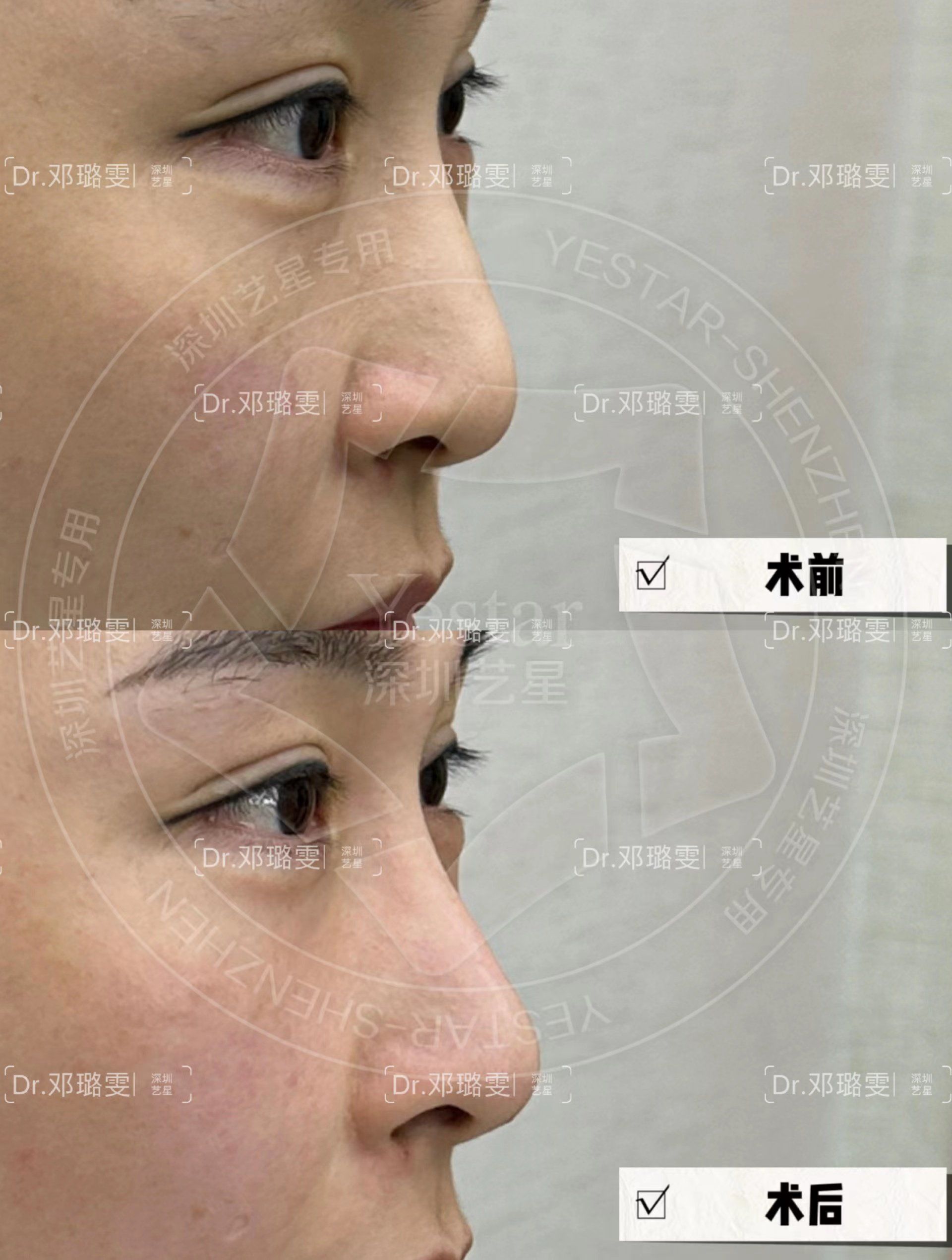 山根低陷的面相