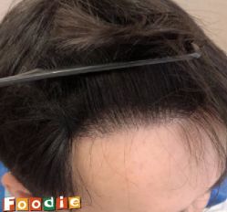 -大麦微针植发丨全国连锁