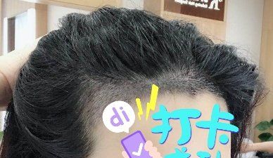 -大麦微针植发全国连锁