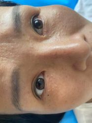 体验前-爱莎扁平疣·汗管瘤·斑痣中心