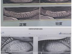 -成都新视界眼科医院·近视手术·儿童近视