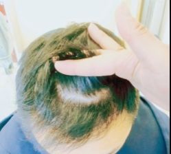 -大麦微针植发丨全国连锁
