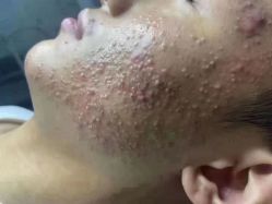 -瑶芳清颜草本祛痘