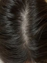 -碧莲盛·不剃发植发