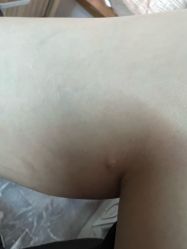 体验后-洁铭新加坡医美