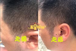-爱莎扁平疣·汗管瘤·斑痣中心
