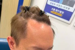 -大麦微针植发全国连锁
