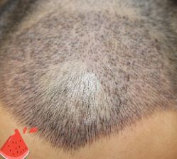 -大麦微针植发丨全国连锁