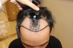 -大麦微针植发丨全国连锁