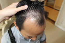 -大麦微针植发丨全国连锁