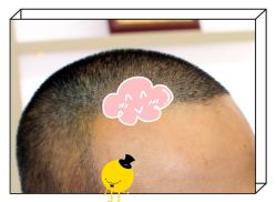 -大麦微针植发全国连锁