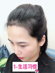 -大麦微针植发全国连锁