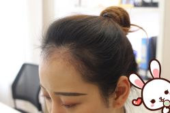 点击看大图 -大麦微针植发丨全国连锁