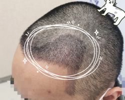 -大麦微针植发全国连锁