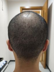 体验后-大麦微针植发全国连锁