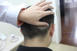 点击看大图 -大麦微针植发丨全国连锁