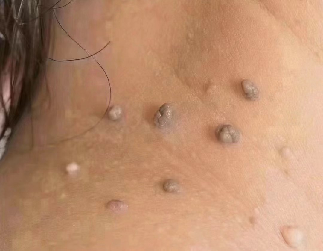 疣是由人乳头瘤病毒引起的表皮良性赘生物