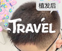 -大麦微针植发全国连锁