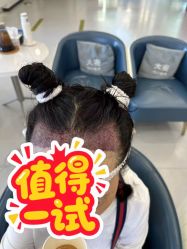 -大麦微针植发全国连锁