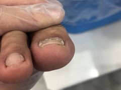 -Andrew指甲专科灰指甲·甲沟炎矫正·3D步态矫形鞋垫定制(浦三路店)