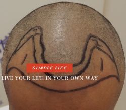 -大麦微针植发全国连锁