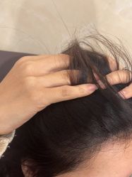 -碧莲盛·不剃发植发