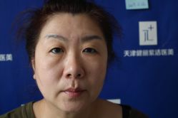 -天津健丽·去眼袋医疗美容机构