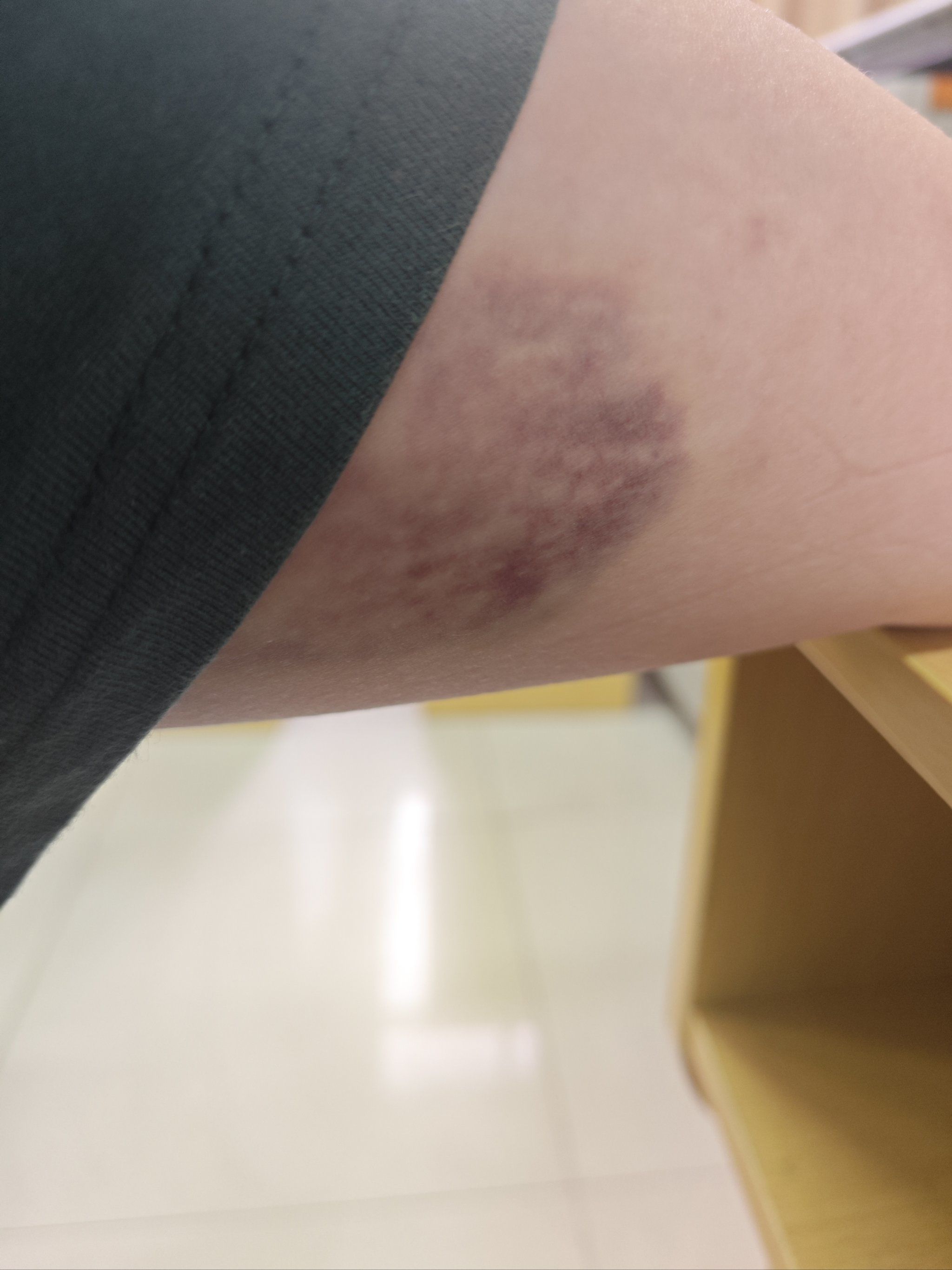 好像我就是随便撞一下,就会青紫很久